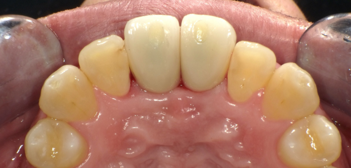 インプラント後