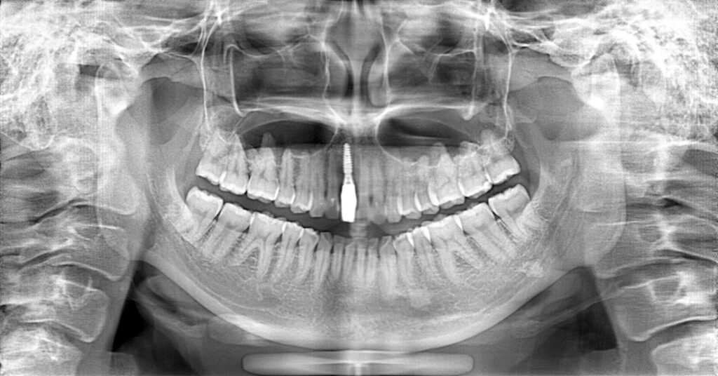 インプラント症例アフター