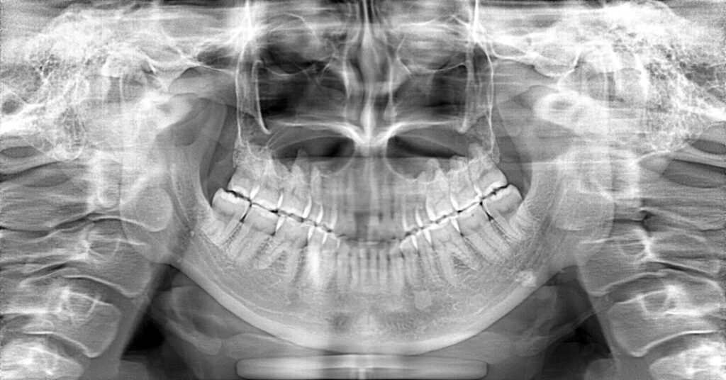 インプラント症例ビフォー