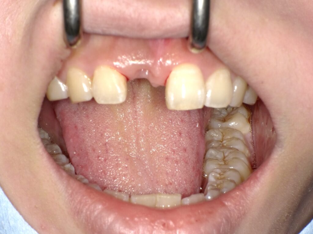 インプラント症例ビフォー