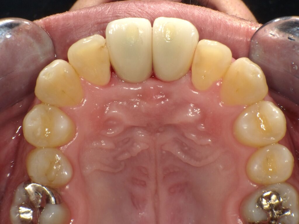 インプラント症例アフター