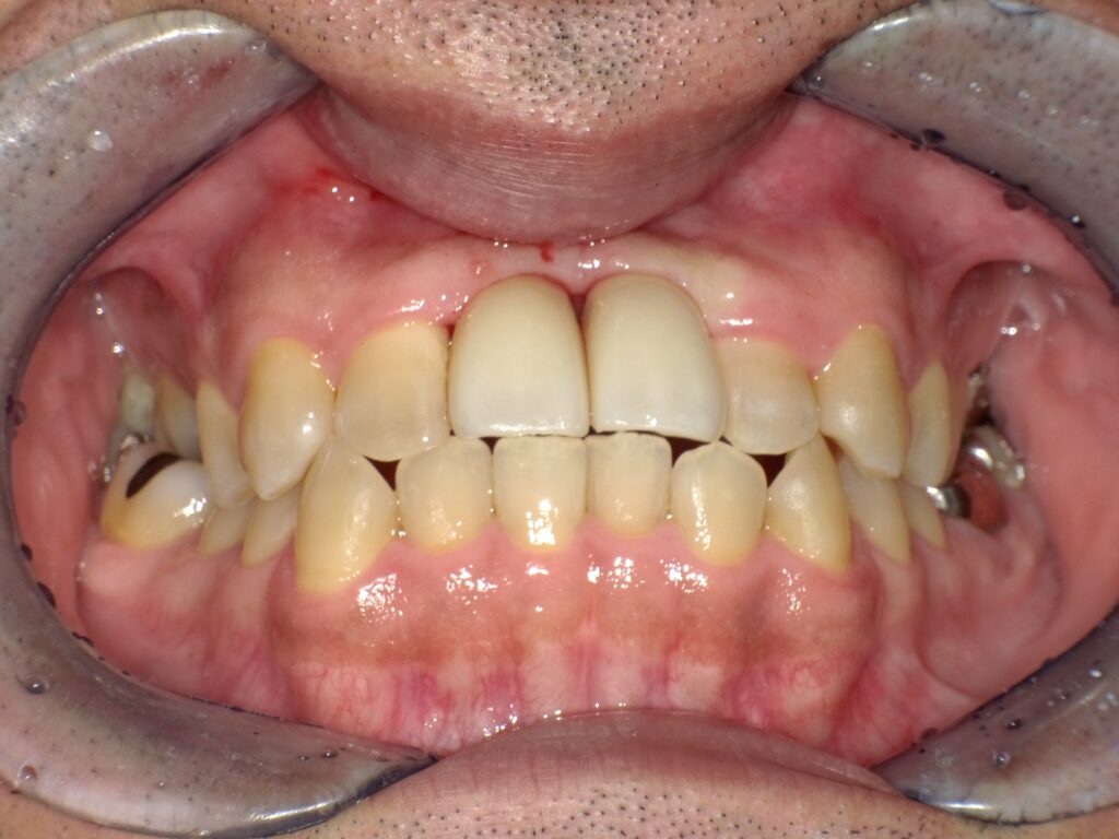 インプラント症例アフター