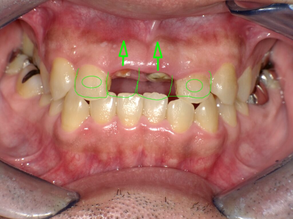 インプラント症例ビフォー