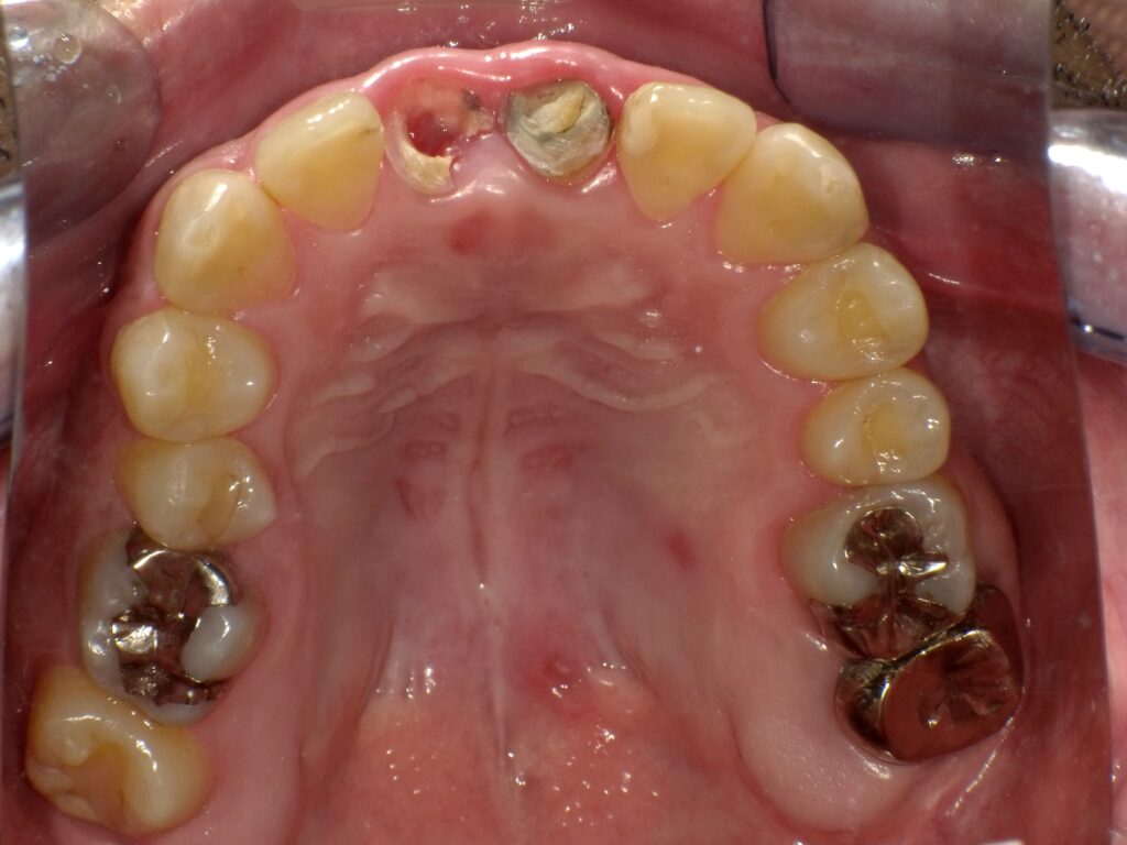 インプラント症例ビフォー