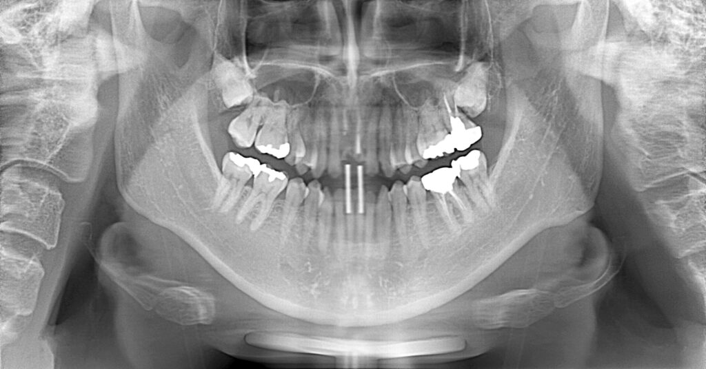 インプラント症例ビフォー