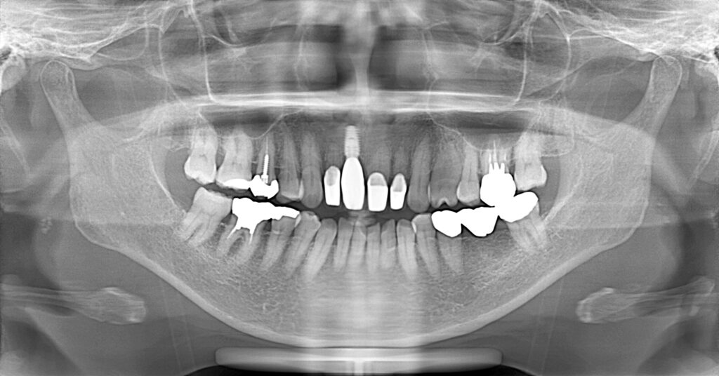 インプラント症例アフター