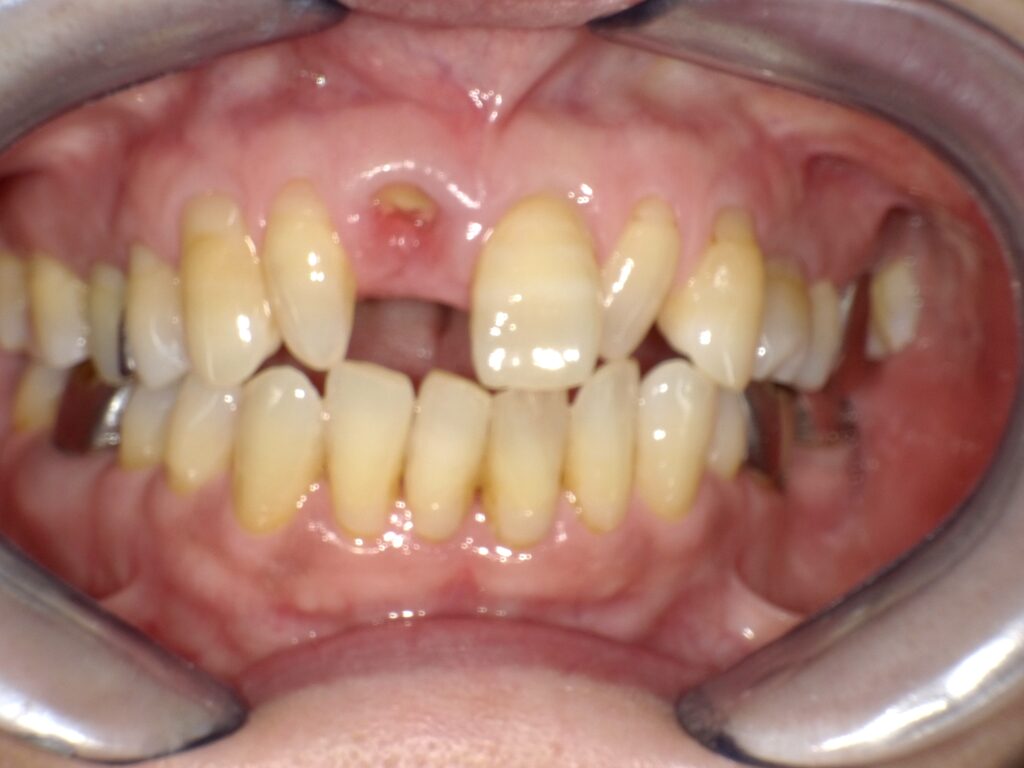 インプラント症例ビフォー