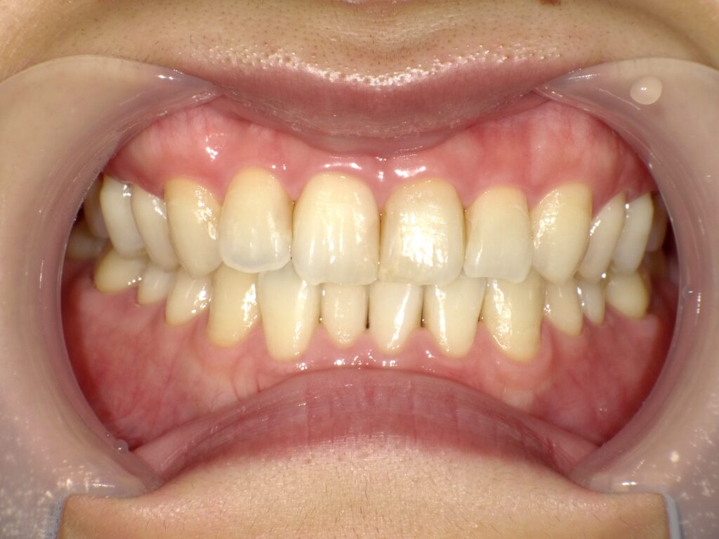 ホワイトニング症例アフター