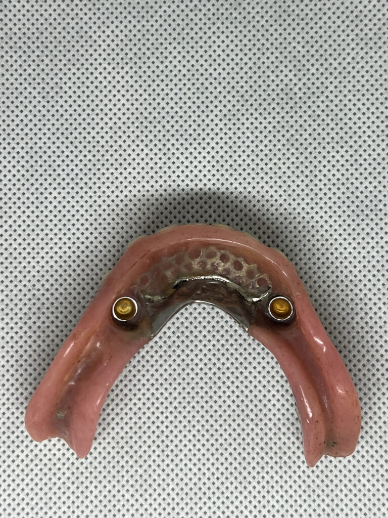 ロケーター義歯