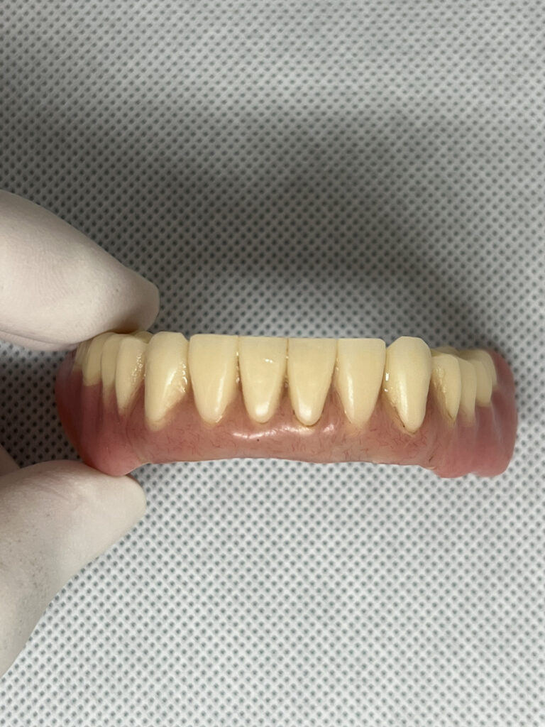 ロケーター義歯