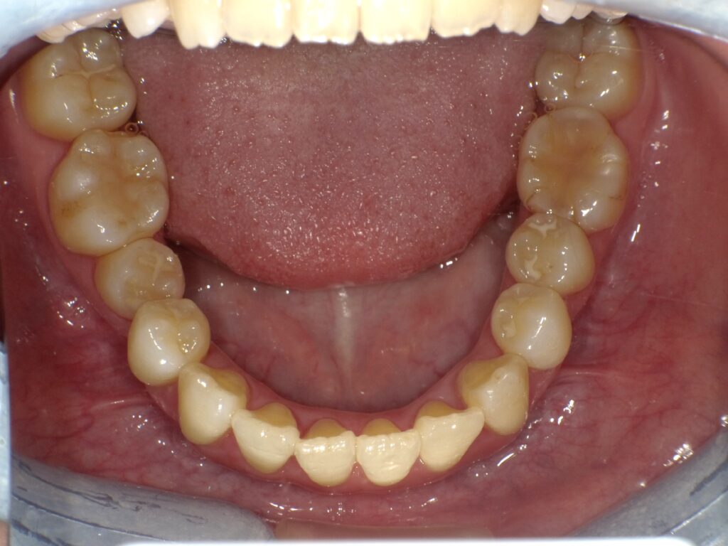 インビザライン症例アフター