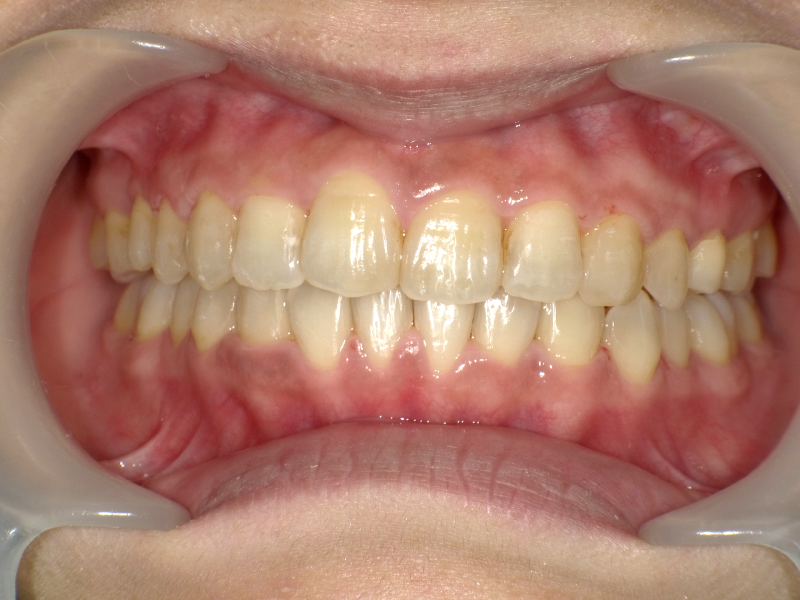 インビザライン症例アフター