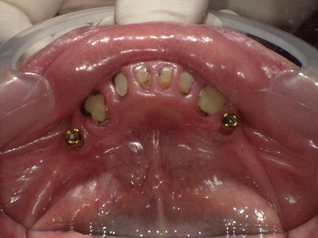 インプラントロケーター義歯症例ビフォー
