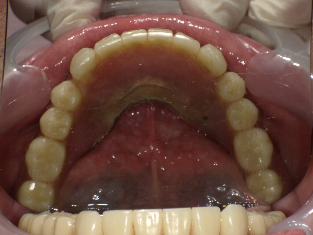 インプラントロケーター義歯症例アフター