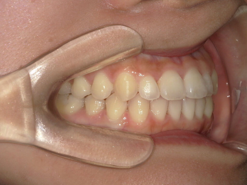 インビザライン症例アフター