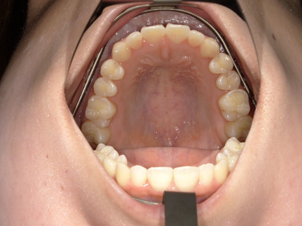 インビザライン症例アフター